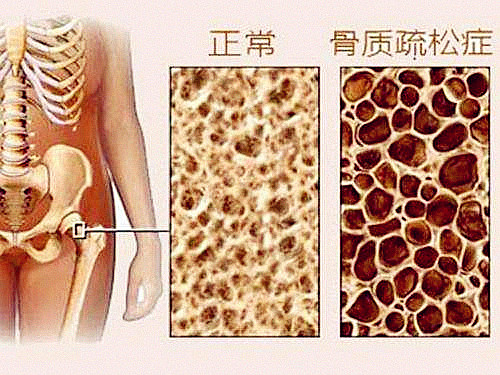 它骨骼強度的主要指標、簡單方便、安全靠譜對骨代謝有很重要作用