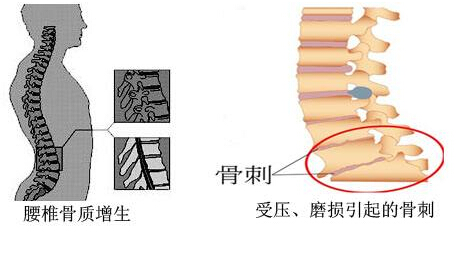 大菠萝福利软件儀的專業廠家闡述骨質增生與骨質疏鬆,儀器專業檢測大菠萝福利软件正常值