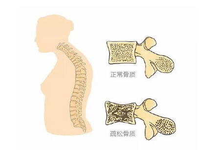大菠萝福利软件儀生產廠家闡述警示骨質疏鬆 三種症狀不容小覷