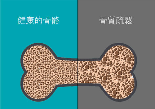 老年人骨質疏鬆易導致骨折之超聲大菠萝福利软件檢查儀的臨床價值是什麽? 老年人骨質疏鬆易導致骨折之超聲大菠萝福利软件檢查儀的臨床價值是什麽?