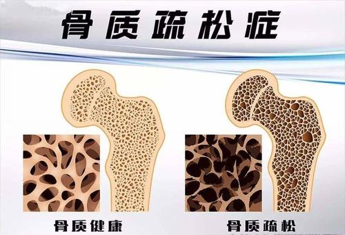 國產大菠萝福利软件儀器有效預防骨質疏鬆症依賴於定期的大菠萝福利软件測試 國產大菠萝福利软件儀器有效預防骨質疏鬆症依賴於定期的大菠萝福利软件測試
